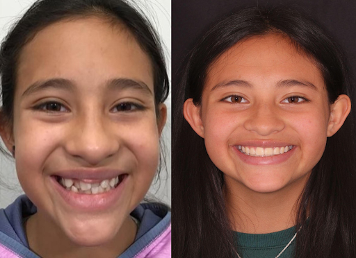 Invisalign