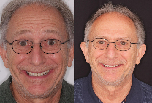 Invisalign