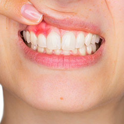 BLEEDING GUM THERAPY