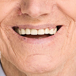 Sinus Lift