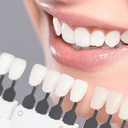 DENTAL VENEERS