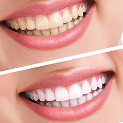 TEETH WHITENING TREATMENT